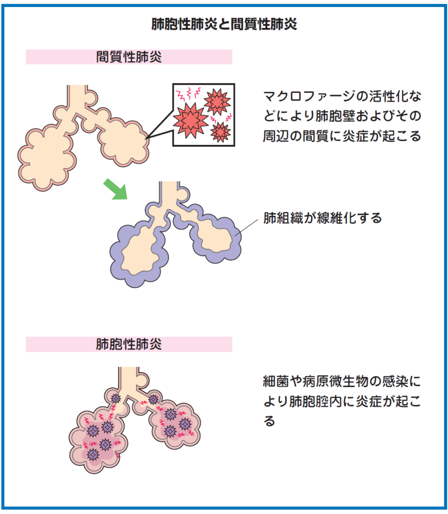 「命に関わる可能性がある「間質性肺炎」」・古河市で筋肉を軟らかくして痛みを改善する口コミでおすすめの治療院！！！ 総和治療院