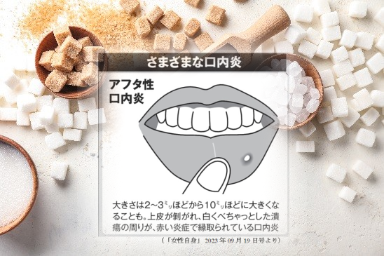 口内炎”に注意し口腔がんの早期発見を」・古河市で筋肉を軟らかくして痛みを改善する口コミでおすすめの治療院!!! – 総和治療院